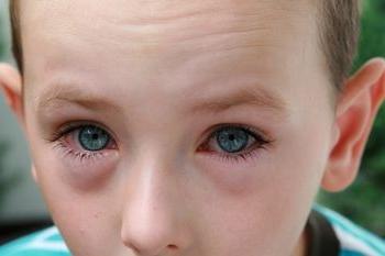 एक बच्चे में नेत्रश्लेष्मलाशोथ: कारणों लक्षण, उपचार